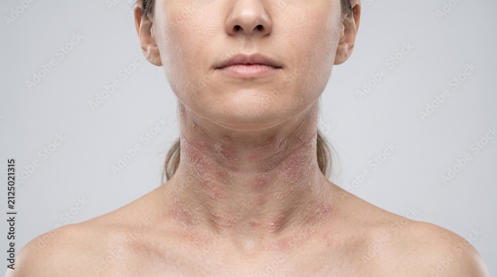 Naklejka premium Portrait of a woman with severe eczema, atopic dermatitis, or allergic skin reaction on her neck