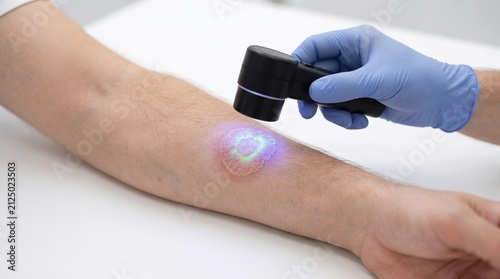 Dermatologist using dermatoscope with UV light to examine fungal infection ringworm lesion on patient arm
