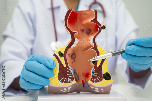 Принти на полотні Asian doctor with rectum and hemorrhoid human anatomy model at hospital, inflamed vascular structure