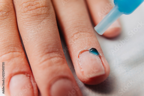Closeup of a finger with a drop of blue medical liquid applied to the nail from an applicator tip showing skin texture and natural nail for healthcare and podiatry concepts