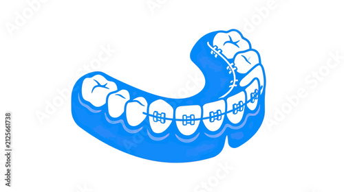 Dental Braces on Teeth, Orthodontic Treatment Illustration