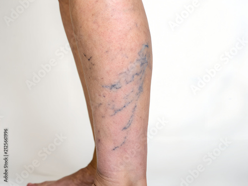 Varicose Veins on Legs	
