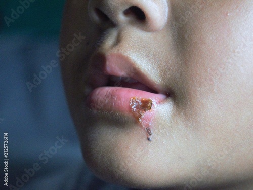 Obraz na płótnie A close-up view of an Asian child's mouth showing a ruptured burn blister on the lower lip, now presenting with a thick yellowish-brown honey-colored crust from secondary infection