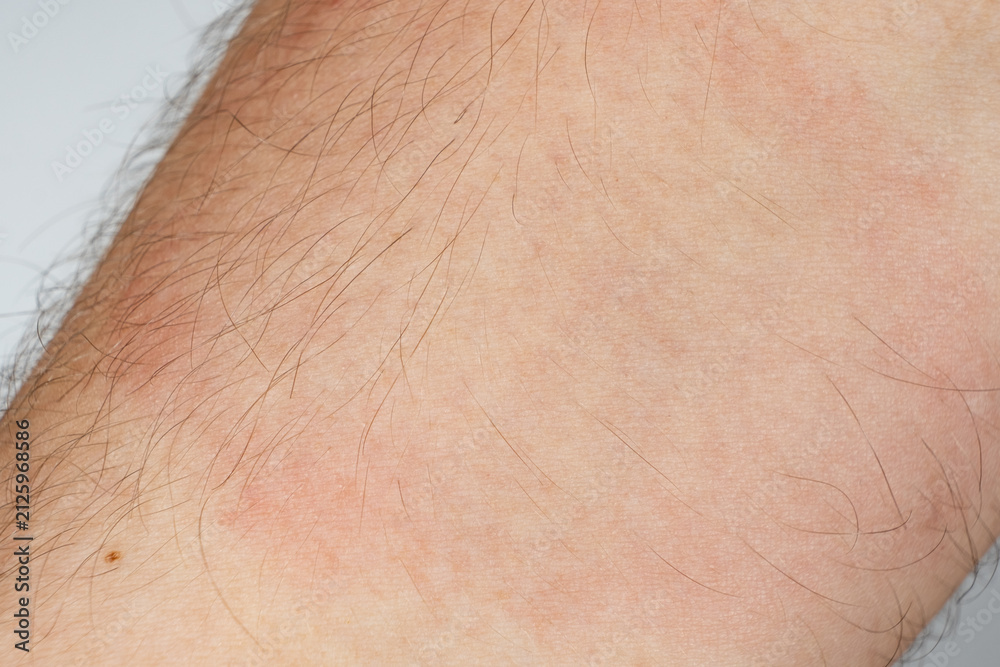 Fototapeta premium Medical symptom of Lyme disease with characteristic red ring rash on human body