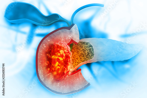 Pancreas or pancreatic cancer with organs and tumors. cancerous cells 3d illustration