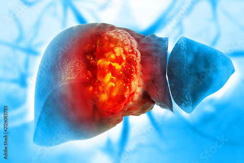 Liver cancer with organs and tumors. cancerous cells 3d illustration