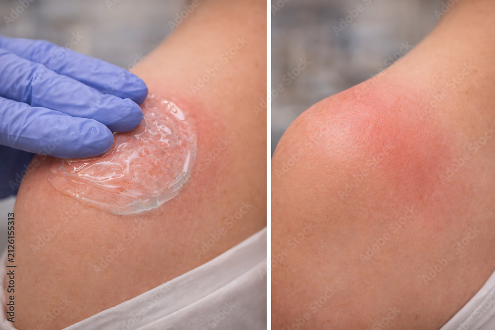 Fototapeta premium Gloved hand applying cooling gel to red shoulder after sunburn treatment
