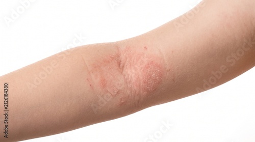 Atopic Dermatitis (Eczema) on Child's Elbow