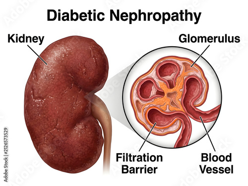 Diabetic nephropathy kidney and glomerulus anatomy illustration isolated on white background