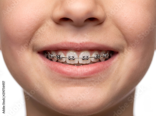 Close-up of child smiling wearing metal dental orthodontic braces with dentistry