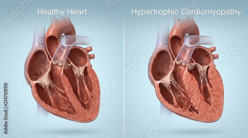 Healthy Heart vs Hypertrophic Cardiomyopathy Cross Section Medical Visual