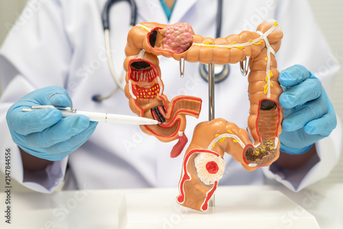 Принти на полотні Colorectal cancer, doctor holding intestine colon human anatomy model