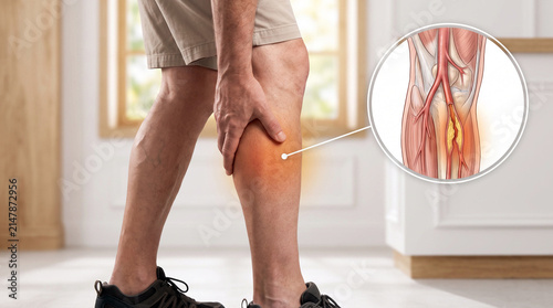 Man Suffering From Peripheral Artery Disease and Claudication Pain With Artery Anatomy Overlay