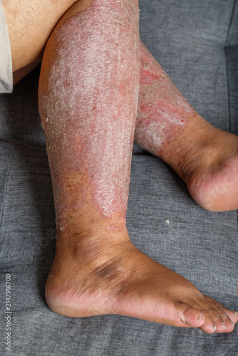 Close-up of inflamed dry scaly skin on a human leg, A chronic skin condition with redness, irritation, and flaky texture for healthcare and dermatology