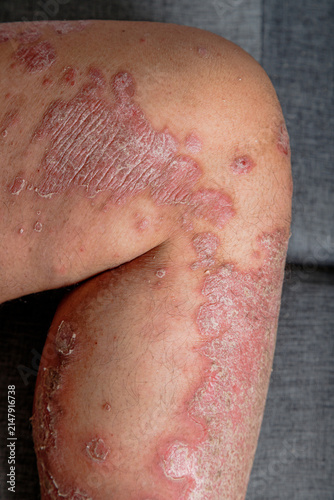 Obraz na plátně Close-up of inflamed dry scaly skin on a human leg, A chronic skin condition wit