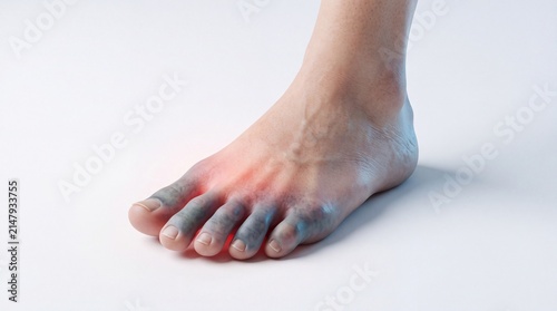 Blue Toe Syndrome with Poor Blood Circulation in Human Foot Medical Illustration