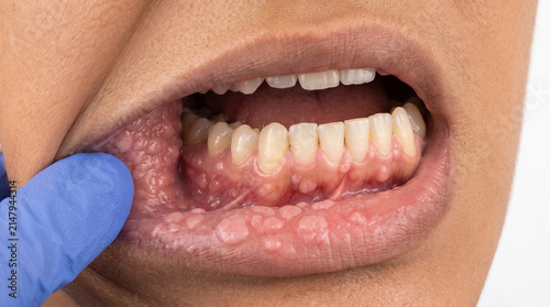 Canvastavla Multiple Soft Pink Nodules Inside Lower Lip and Gums  - Intraoral View of Multif