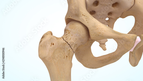 Femur bone non displaced fracture of 3d illustration