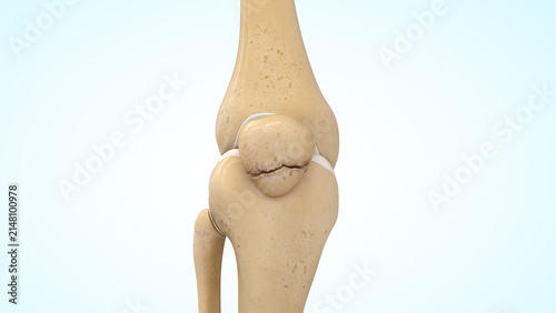 Lower pole patella fracture of 3d illustration