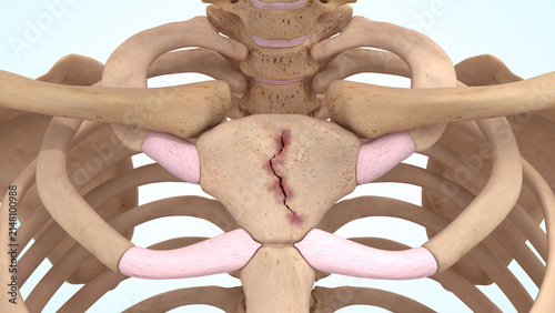 Manubrium bone fracture of 3d illustration