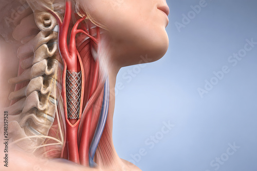 Carotid stent opening neck artery for brain blood flow