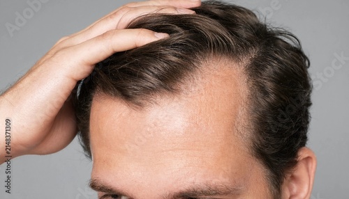 Close up shot of a man showing signs of hair loss and male pattern baldness on his scalp