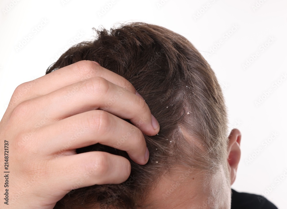 Fototapeta premium Dandruff problem. Man examining his head on white background, closeup