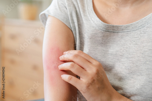 Obraz na plátně Sensitive skin allergic concept, Woman itching on her arm have a red rash from a