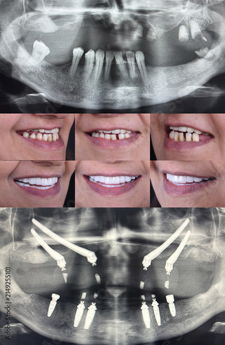 Fixed full arch implant supported dental prosthesis applied to edentulous individuals in dentistry. Full arch dental prosthesis fixed on only four implants. This implant surgery
