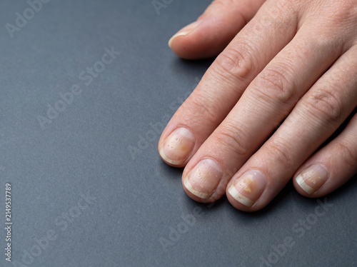 Nail Psoriasis Showing Pitting Onycholysis and Oil Drop Discolouration on Adult Fingernails, Macro Dermatology Medical Image