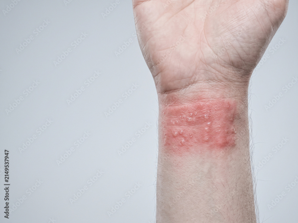 Fototapeta premium Allergic Contact Dermatitis Sharp Bordered Red Rash on Adult Wrist from Metal Sensitivity, Dermatology Patch Test Reference Photograph