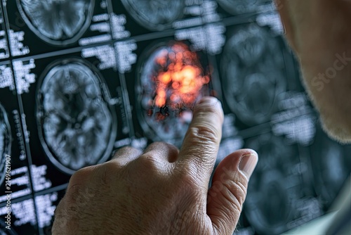 Doctor examining MRI scans, focusing on a brightly highlighted brain anomaly