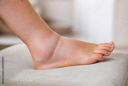 Swollen ankle resting on neutral cushion, injury recovery and healthcare concept