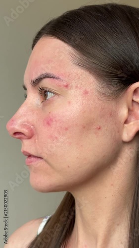 Vertical close up video of a young woman face demonstrating skin inflammation, redness and papulopustular rosacea flare up during exacerbation.