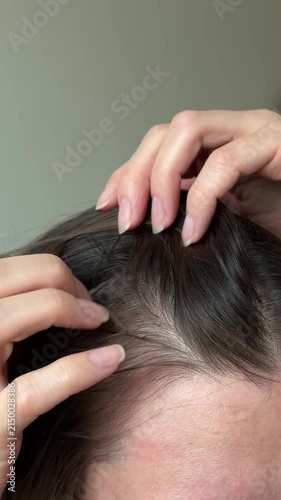 Vertical video close up of woman showing thinning hair and hair loss on her temples. Concept of alopecia, trichology, hair care problem and treatment.