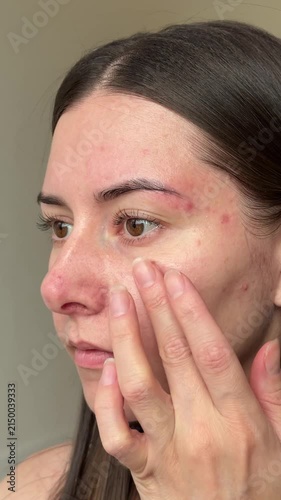 Vertical close up video of a young woman with inflamed red skin and papulopustular rosacea applying medical treatment cream or soothing serum to her face.