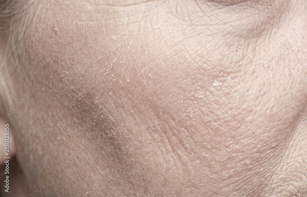 Fototapeta premium Extreme close-up of mature, aging skin on a face showing extreme dryness, fine flaking, crepey texture, and prominent wrinkles.