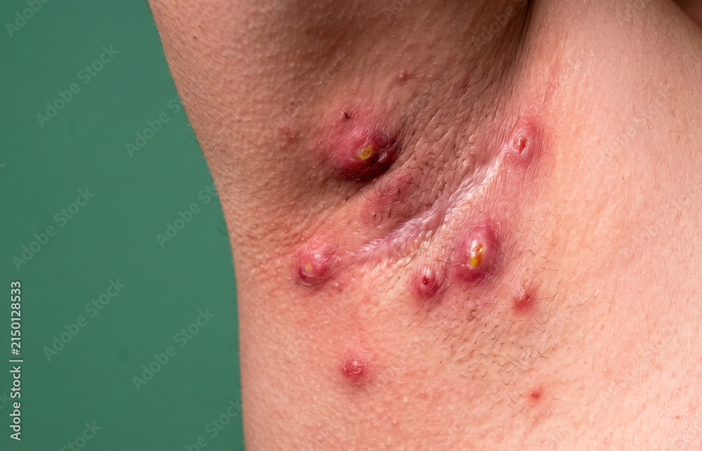 Fototapeta premium Severe hidradenitis suppurativa abscesses and chronic scarring in the axilla underarm region of patient