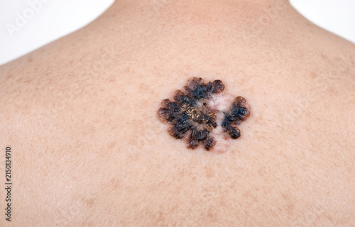 Macro view of an irregular dark melanoma skin lesion and atypical nevus on back