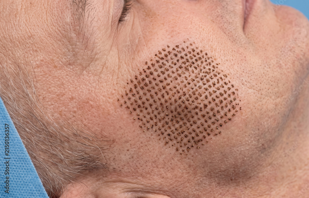 Naklejka premium Close up of fractional laser resurfacing grid marks and micro scabs on patient cheek