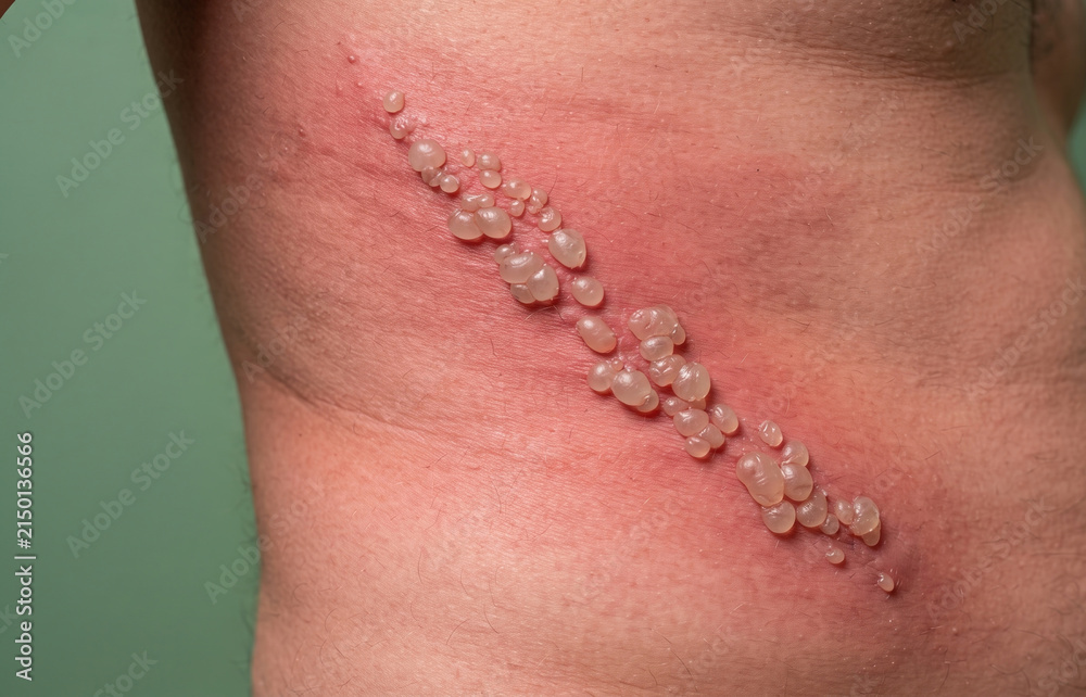 Fototapeta premium Close up of painful shingles herpes zoster blisters and fluid filled vesicles on human torso