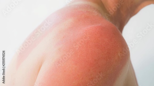 Close up of human shoulder with red sunburn skin damage on light background