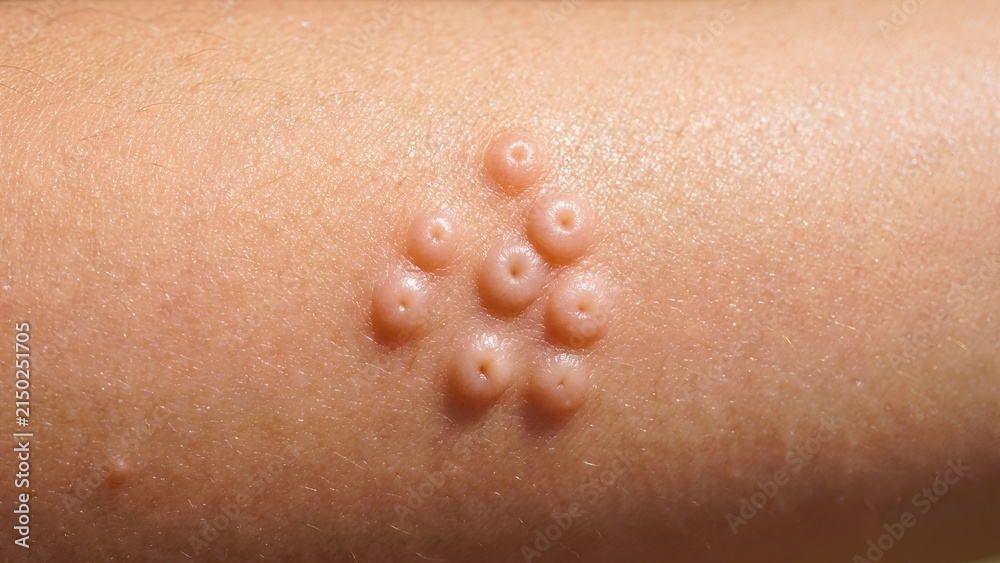 Fototapeta premium Clinical close-up of molluscum contagiosum papules on human skin