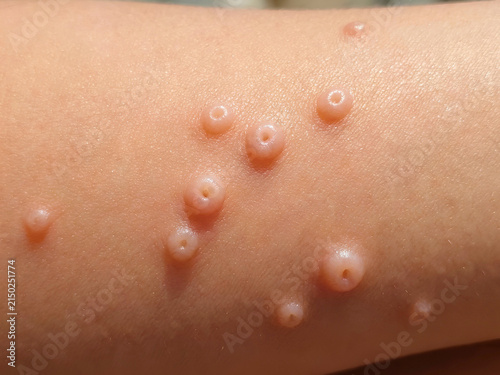Molluscum contagiosum lesions on human skin, clinical dermatology close-up