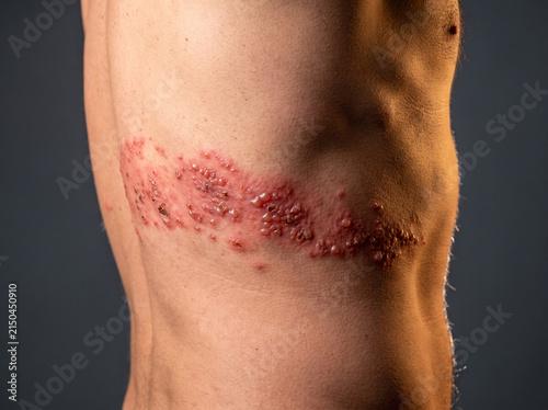 Herpes Zoster Shingles Painful Vesicular Rash Following Dermatome Band on Adult Flank,  Skin Disease Medical Reference Image