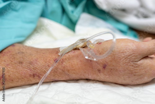 Cuadro en lienzo Close up of an elderly patient hand intravenous cannula medical tubing during ho