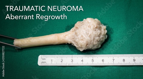 Traumatic neuroma specimen with aberrant nerve regrowth on surgical green background