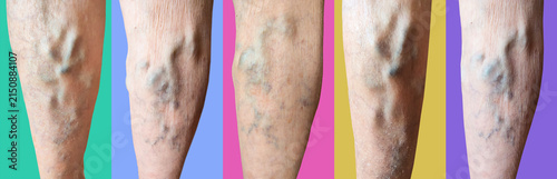 The varicose veins on a legs of old woman closeup