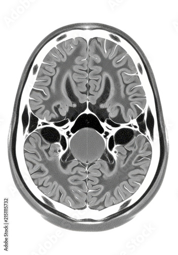 A brain scan showing the cerebral cortex and other brain structures