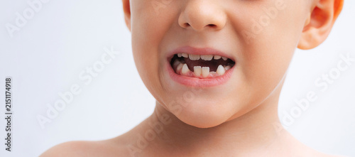 Fotografía portrait of a child with lost baby teeth